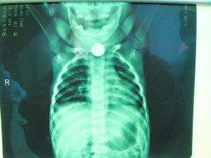 1岁童病痛缠身 拍片发现颈椎处有圆形异物